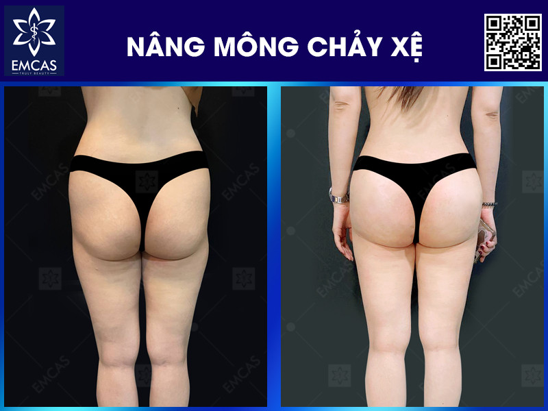 NÂNG MÔNG CHẢY XỆ
