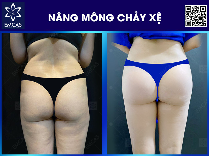 NÂNG MÔNG CHẢY XỆ
