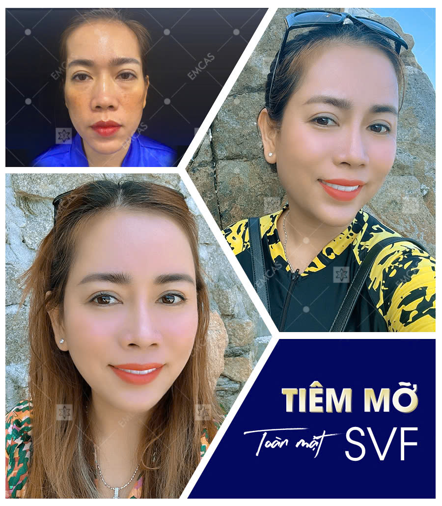 Quy Trình Làm Đầy Vùng Mặt Bằng Mỡ Tự Thân