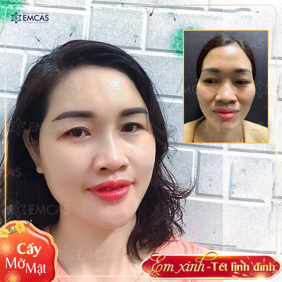 Làm Đẹp Khuôn Mặt An Toàn Bằng Mỡ Tự Thân