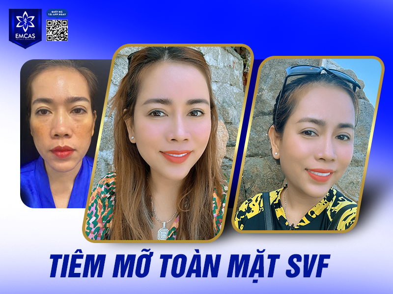 Làm Đẹp Khuôn Mặt An Toàn Bằng Mỡ Tự Thân