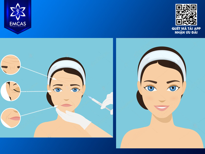 Lợi Ích Của Phương Pháp Tiêm Mỡ Toàn Mặt Là Gì?