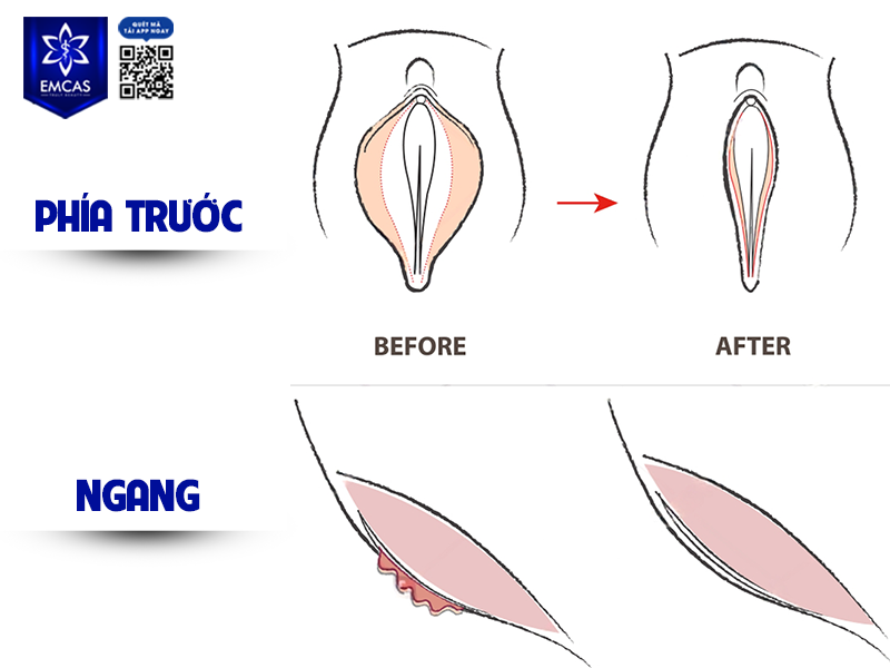  Trẻ Hóa Tầng Sinh Môn – Cải Thiện Thẩm Mỹ, Nâng Cấp Tự Tin