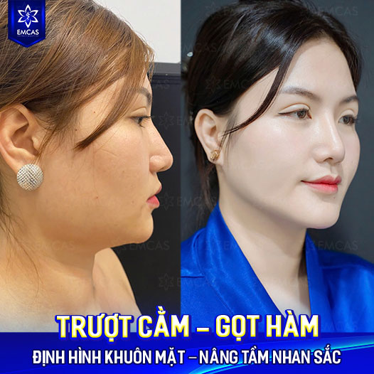 Trượt Cằm - Bí Quyết Tạo Cằm V-Line