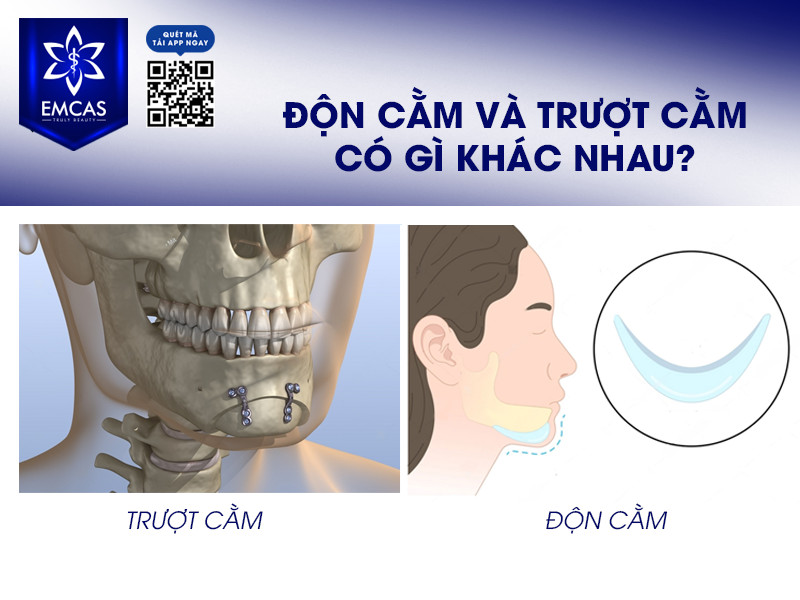 Trượt Cằm Và Những Điều Cần Biết