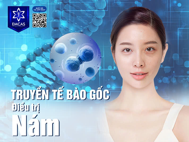 Truyền Tế Bào Gốc Điều Trị Nám