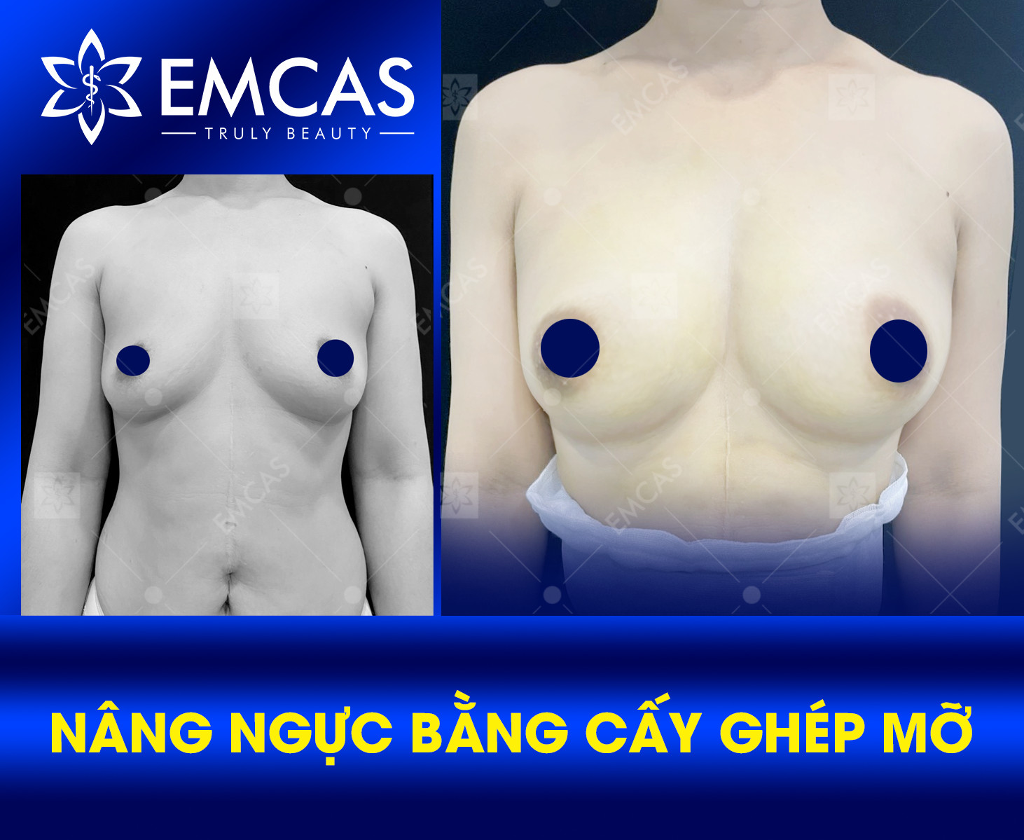 NÂNG NGỰC BẰNG MỠ TỰ THÂN