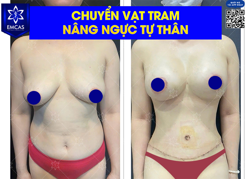 Những Ai Phù Hợp Với Phương Pháp Nâng Ngực Tự Thân?