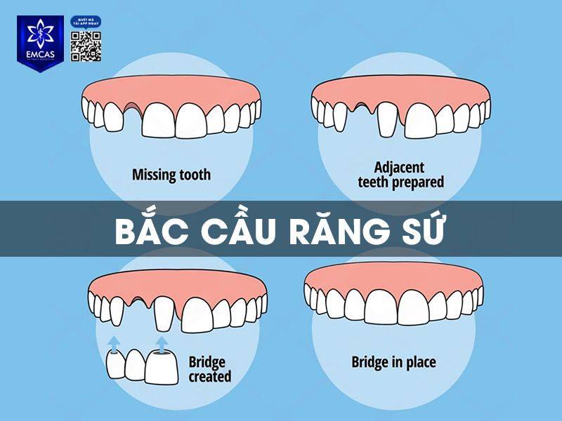 Bắc Cầu Răng Sứ Có Bền Không? Tuổi Thọ Trung Bình Của Răng Sứ