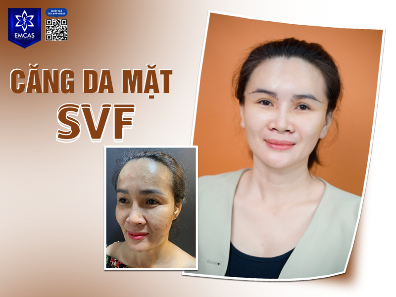  Lợi Ích Khi Căng Da Mặt SVF Tại EMCAS
