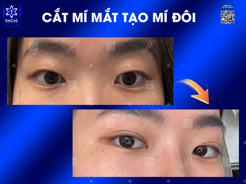 Phương Pháp Cắt Mí Mắt Hiện Đại: An Toàn, Hiệu Quả Và Không Đau Đớn