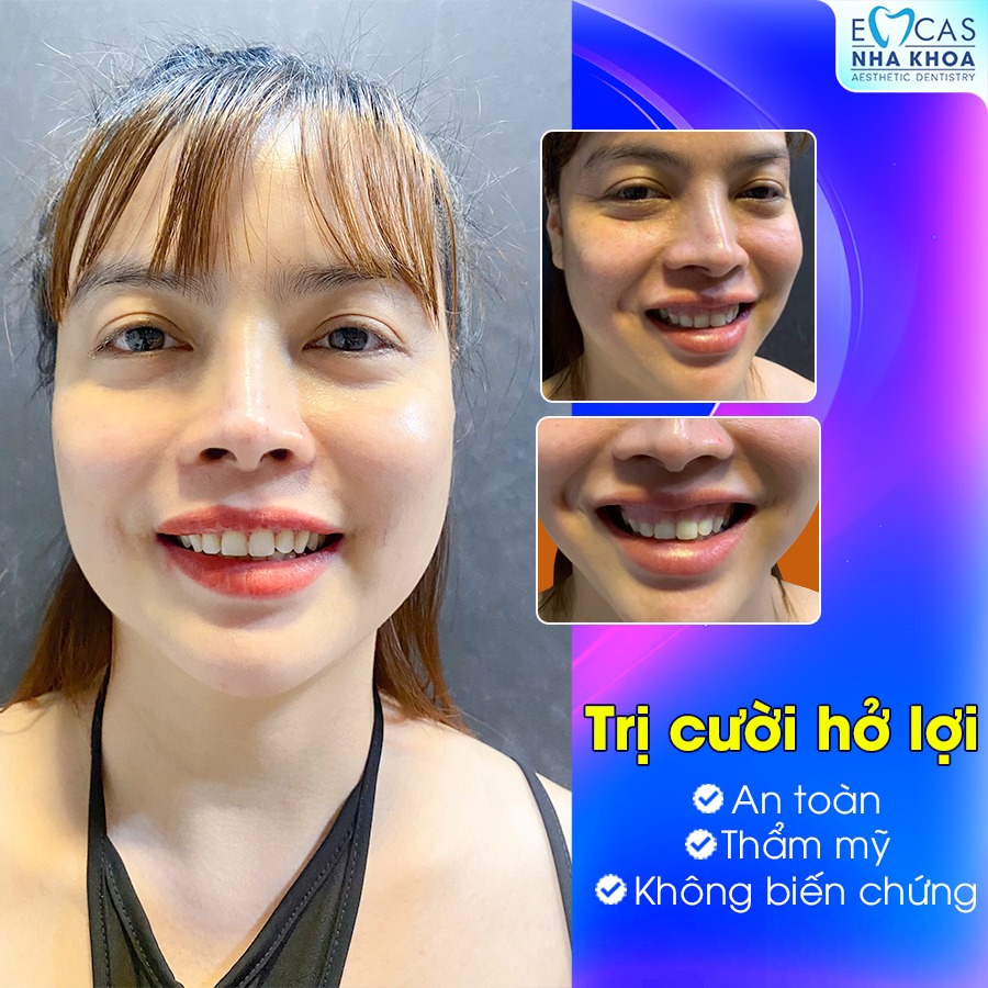 Điều Trị Cười Hở Lợi - Giải Pháp Giúp Bạn Sở Hữu Nụ Cười Tự Tin Hơn