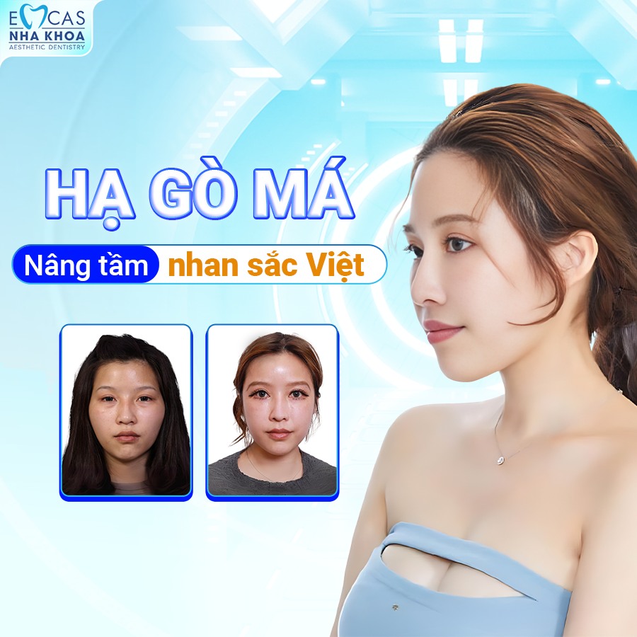 Hạ Gò Má Có Duy Trì Vĩnh Viễn Không?
