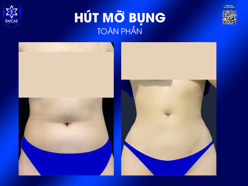 Những Điều Cần Biết Khi Hút Mỡ Bụng