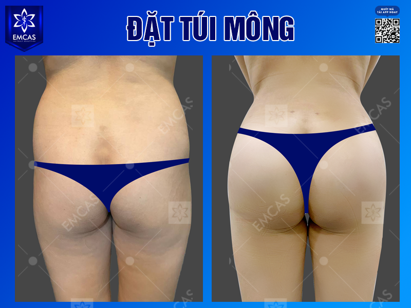 Sau Khi Nâng Mông Có Bị Chảy Xệ Không? Cách Duy Trì Vòng 3 Săn Chắc