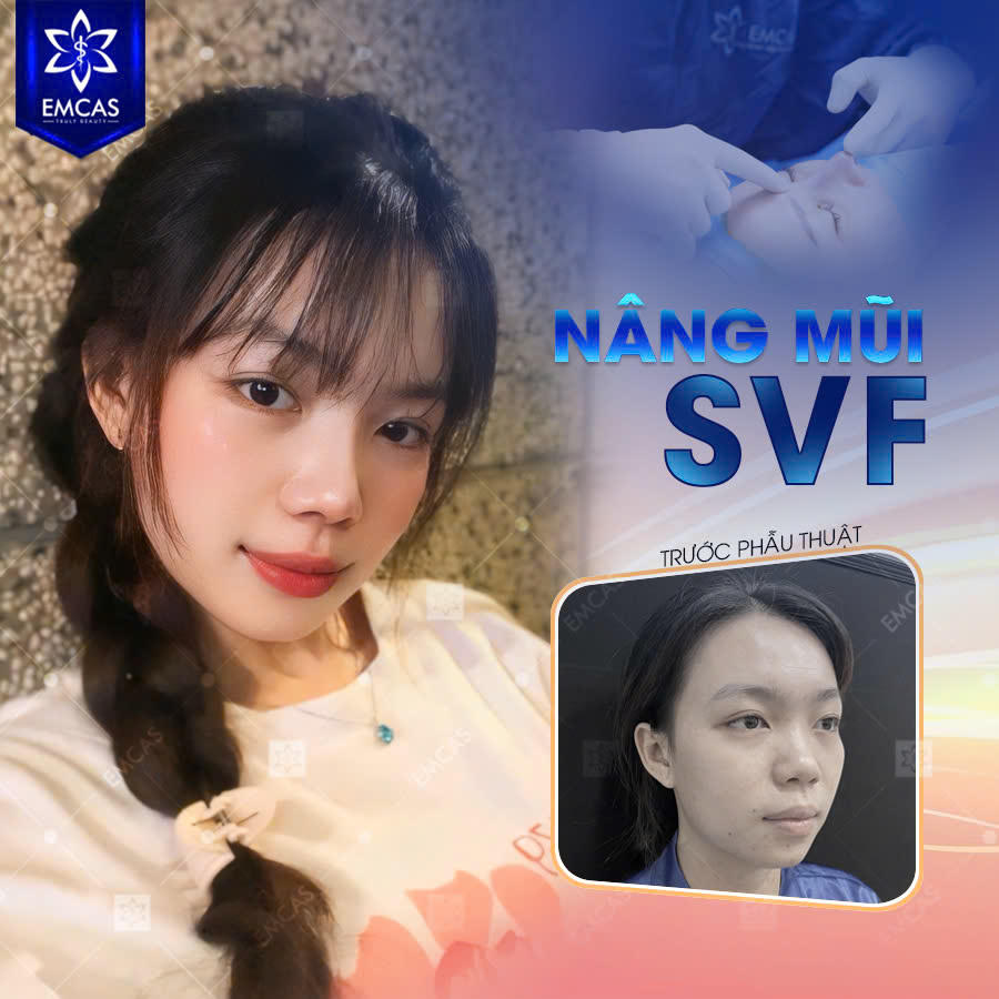 Vì Sao Nên Lựa Chọn Nâng Mũi SVF?
