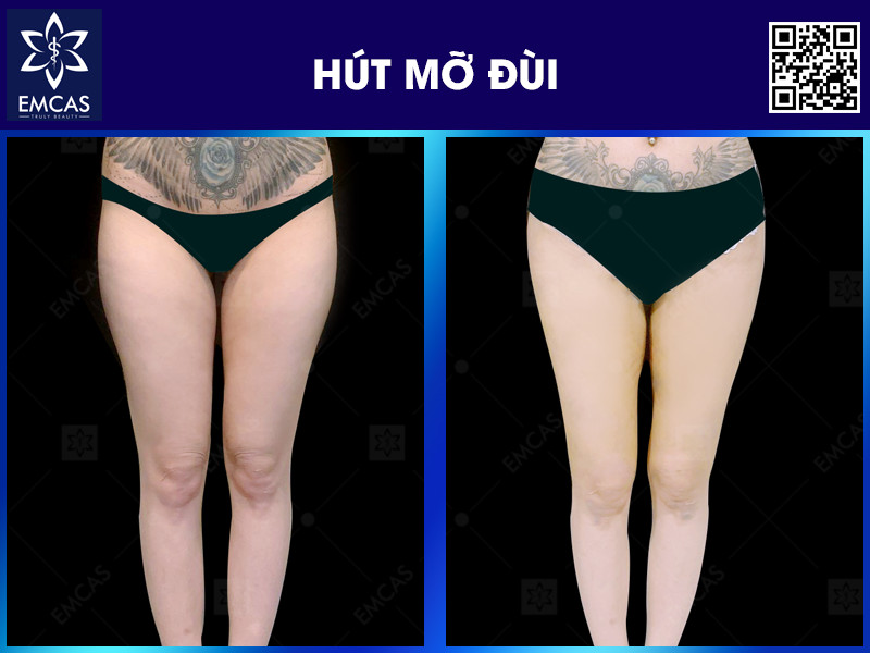 HÚT MỠ ĐÙI