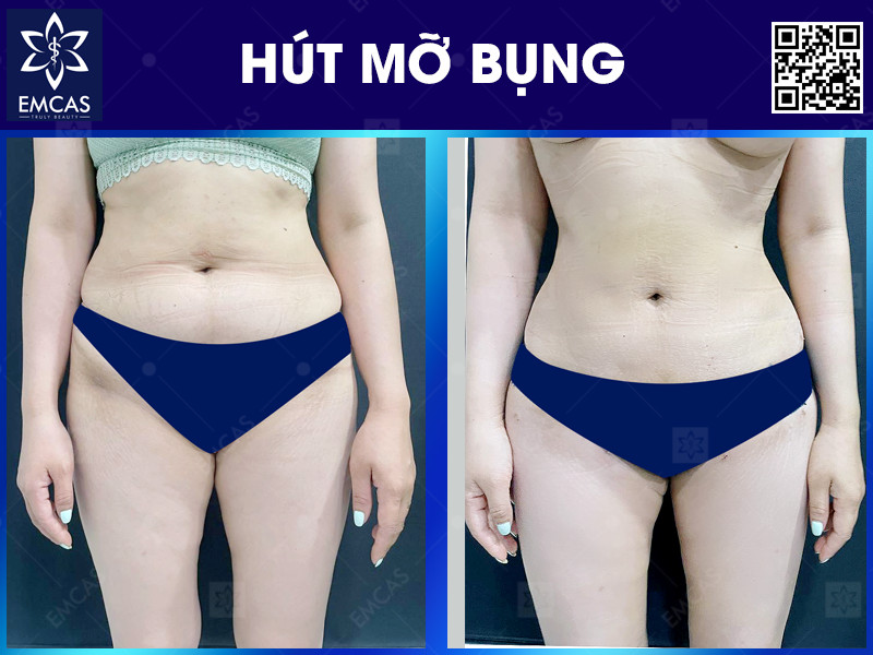 HÚT MỠ BỤNG