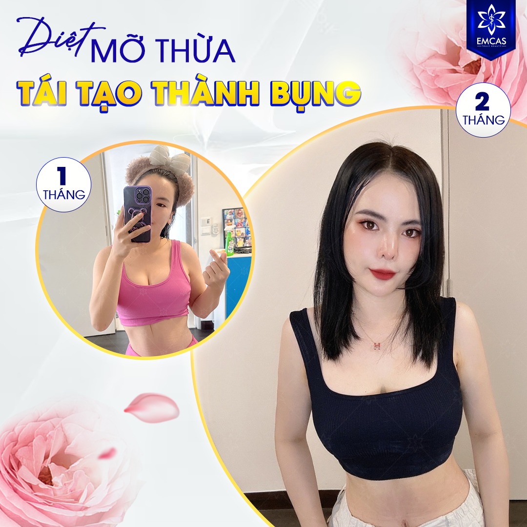 Tái Tạo Thành Bụng Là Gì? Tất Cả Những Điều Bạn Cần Biết