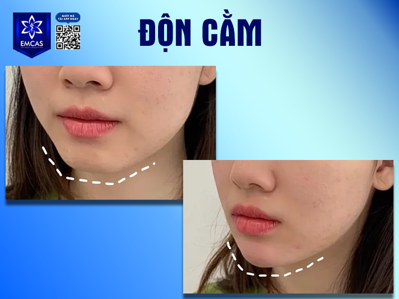 Những Yếu Tố Ảnh Hưởng Đến Kết Quả Độn Cằm