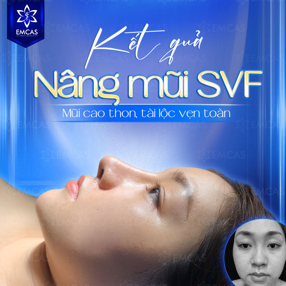 Lý Do Nên Chọn Nâng Mũi SVF Thay Vì Phương Pháp Truyền Thống